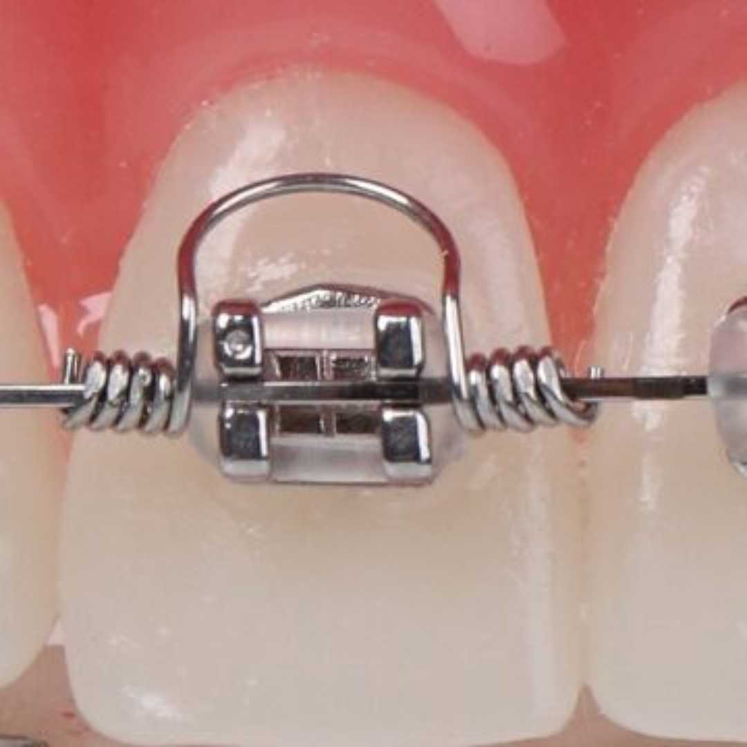 Resorte de torque 3B Orthodontics
